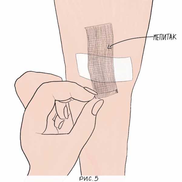 Повязка не прилипающая к ране. Как безболезненно отклеить пластырь. Пластырь заклеивать родинки. Как снять лейкопластырь.